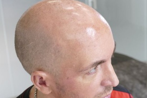 Пересадка волос на голове у мужчин 